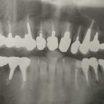 歯のレントゲン